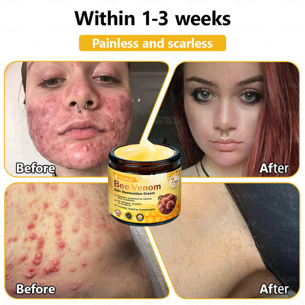 💐🌟💐Made and Shipped from UK ✨ VLSVLS® Bee Venom Skin Restoration Cream 🔥 LAST DAY 80% OFF